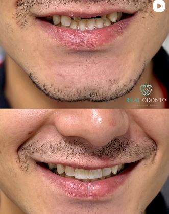 Coroa sobre implante unitário - Real Odonto